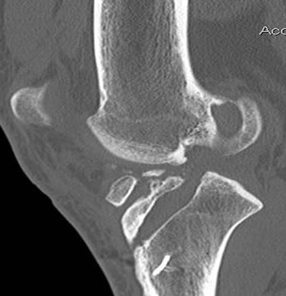 Revision ACL CT Sagittal 2